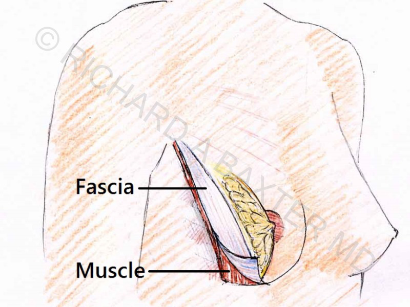 subfasacial breast illustration