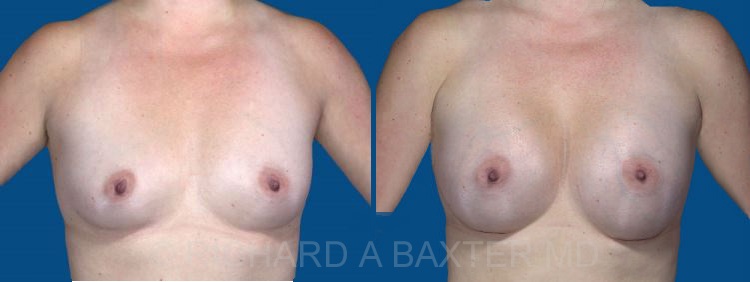 before and after cleavage improvement
