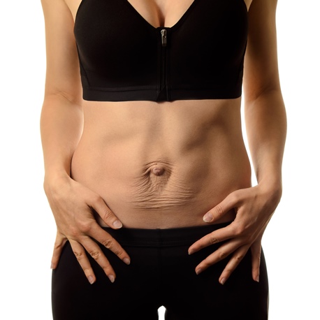 Mind the gap: How to treat post-pregnancy abdominal muscle