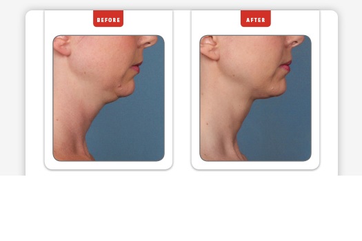 Before and After Kybella