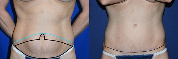 before and after tummy tuck front view