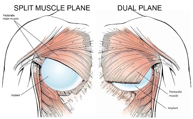 Breast augmentation in athletic women: update - Phase Plastic