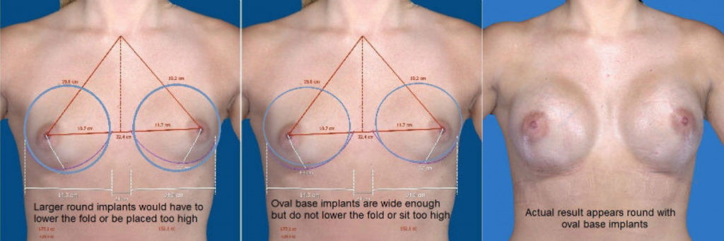 implant graph