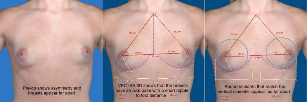 anatomic implant phase plastic surgery