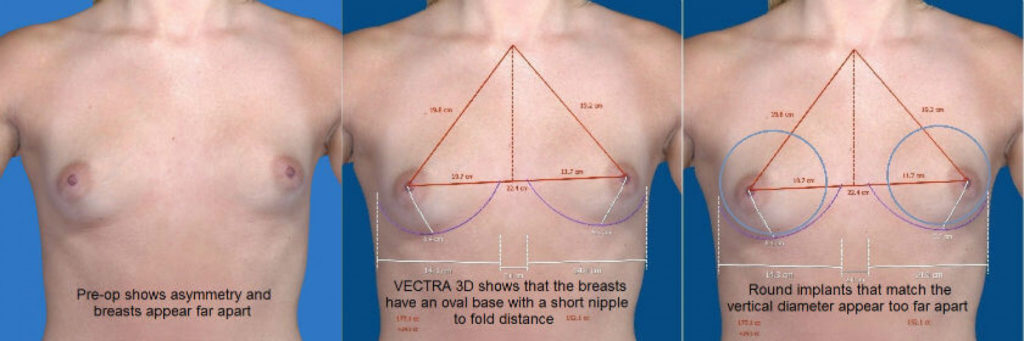 When to Use Form-Stable (Anatomic) Implants - Phase Plastic