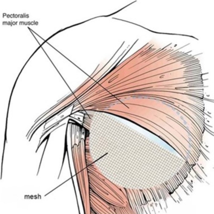 Correction of animation deformity by conversion from dual plane to split muscle and Gala internal bra