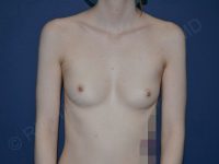 before breast augmentation front view case 3115