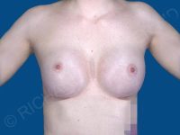 after breast augmentation front view case 3115