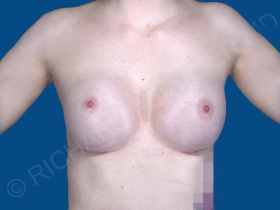 after breast augmentation front view case 3115