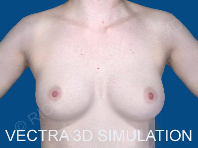 after breast augmentation Vectra 3D Simulation front view