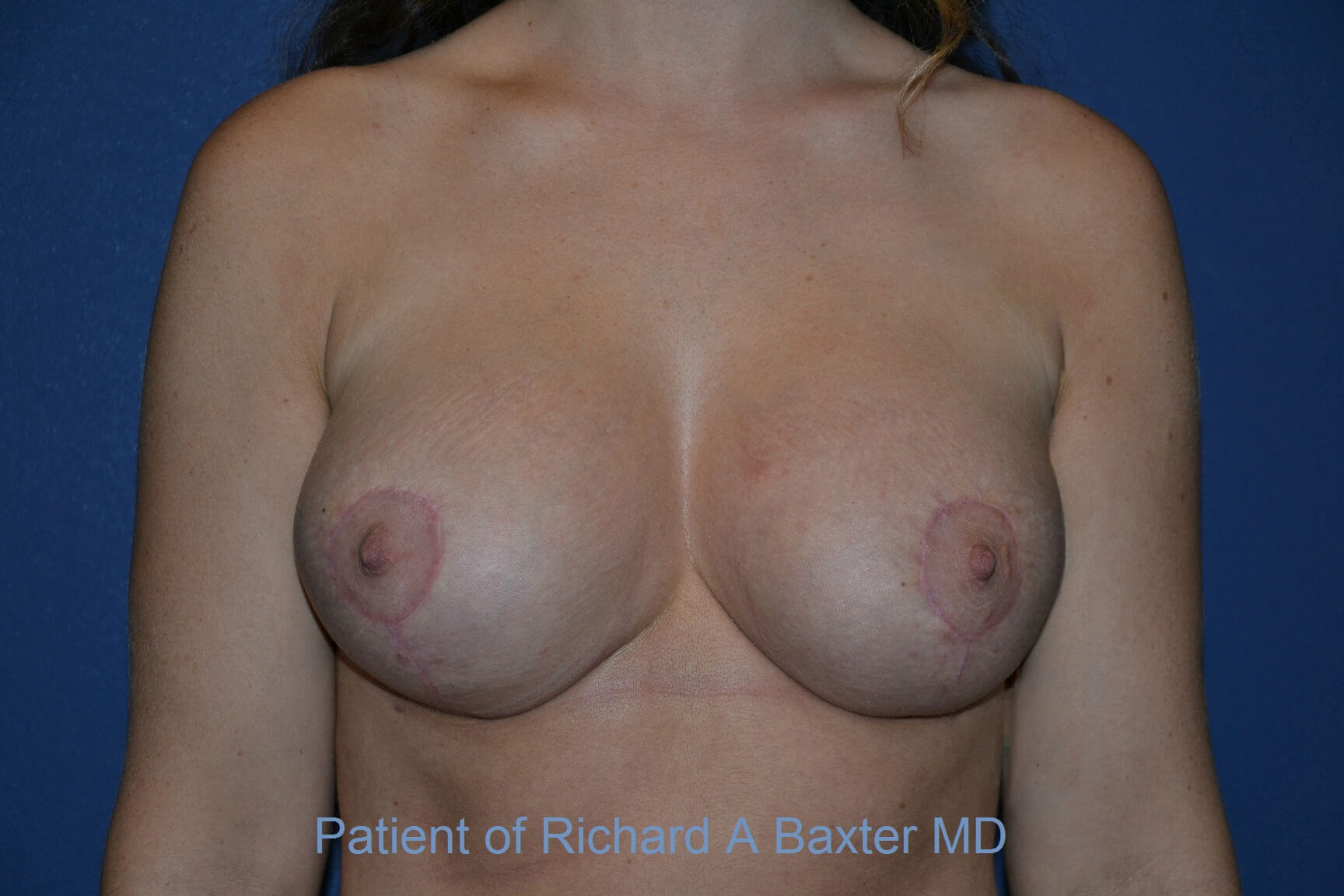 after breast augmentation front view case 3125