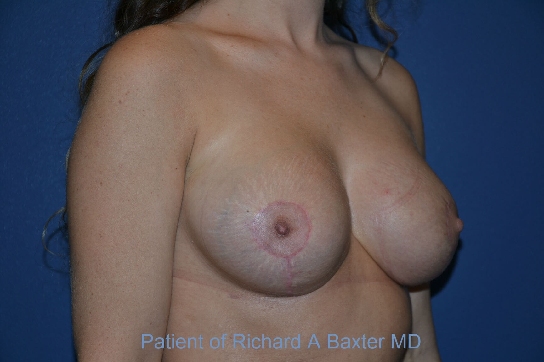after breast augmentation right angled view case 3125