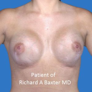 after breast augmentation front view case 3239