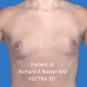 before breast augmentation front view case 3239