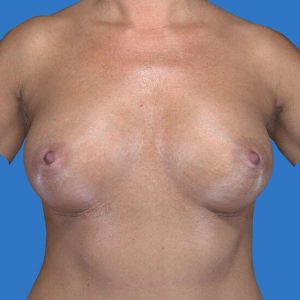 after breast augmentation front view case 3244