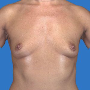 before breast augmentation front view case 3244