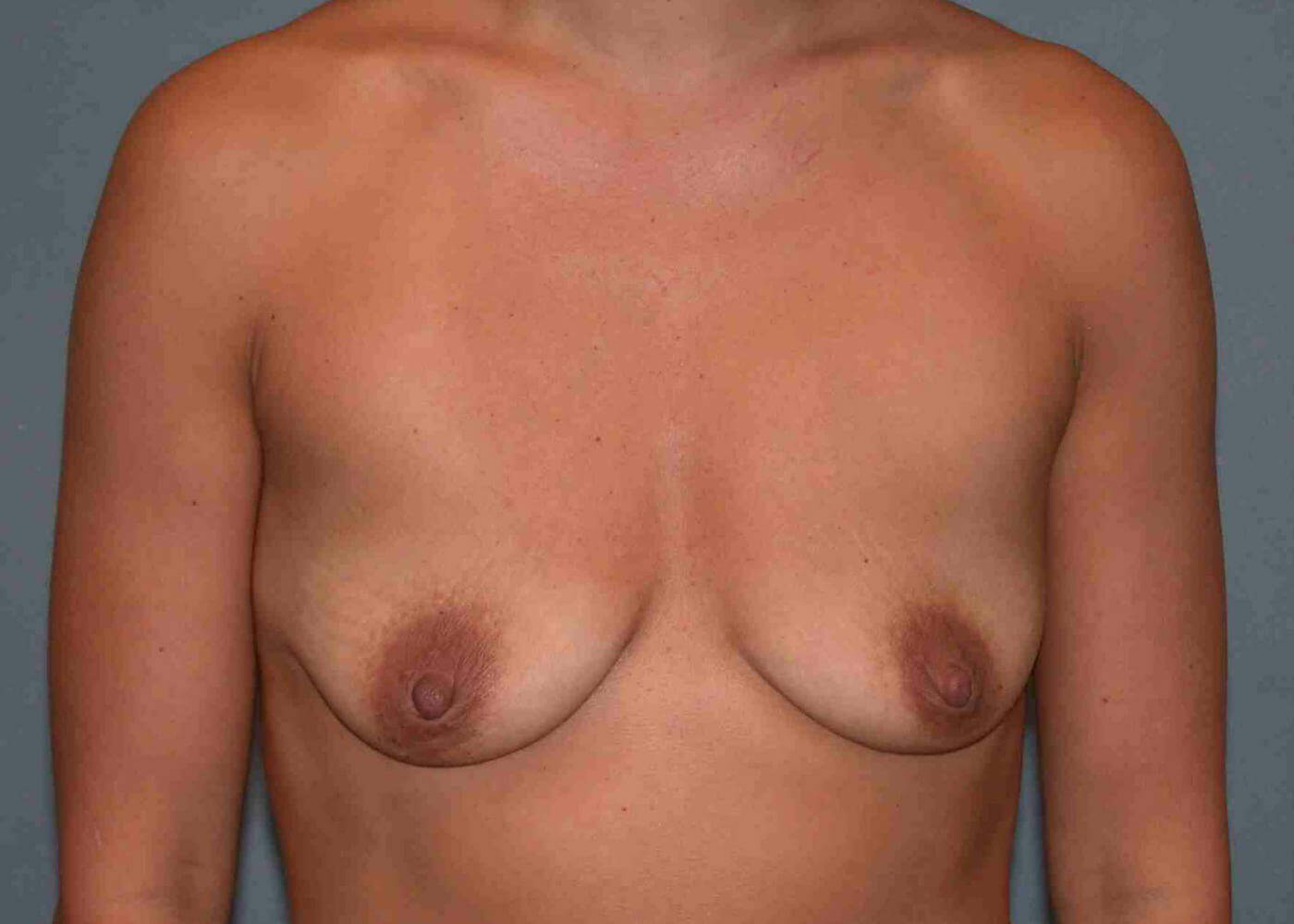 before breast augmentation front view case 3249