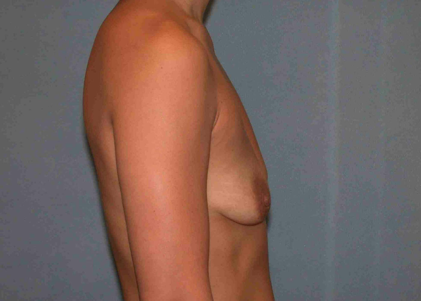 before breast augmentation side view case 3249