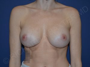after breast augmentation front view case 3256