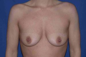 before breast augmentation front view case 3261