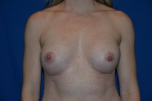 after breast augmentation front view case 3268