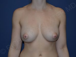 before breast augmentation front view case 3288