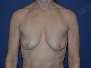 before breast augmentation front view case 3293