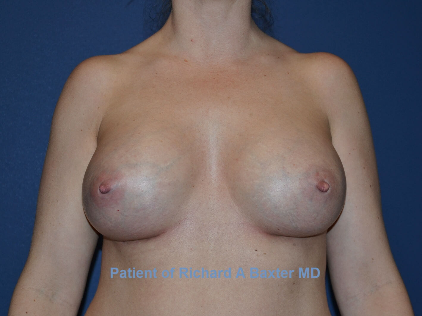 after breast augmentation front view case 3310