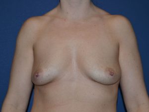 before breast augmentation front view case 3310