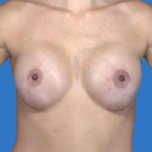 after breast augmentation front view case 3315