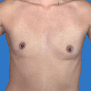 before breast augmentation front view case 3315