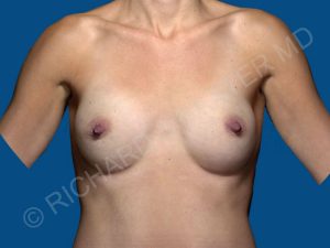 after breast augmentation front view case 3320