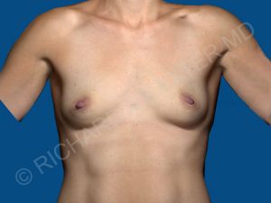 before breast augmentation front view case 3320