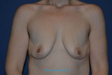 before breast augmentation front view case 3325