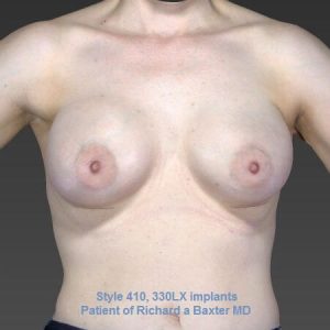 after breast augmentation front view female patient case 3330