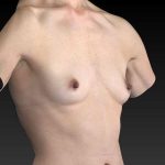 before breast augmentation angle view case 3389