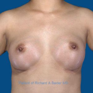 after breast augmentation front view case 3399