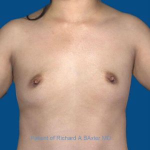 before breast augmentation front view case 3399