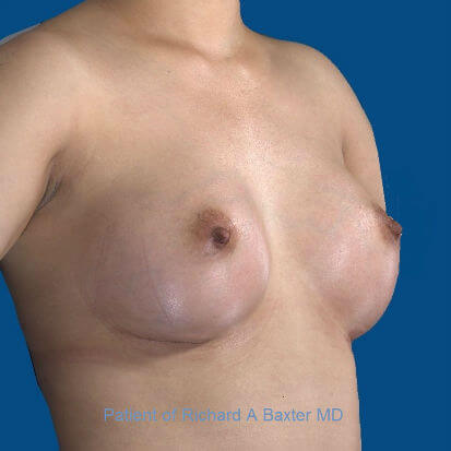 after breast augmentation angle view case 3399