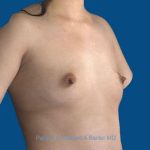 before breast augmentation angle view case 3399