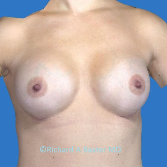 after breast augmentation front view case 3404