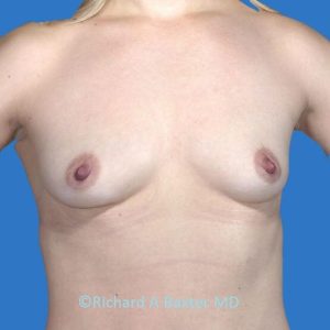 before breast augmentation front view case 3404