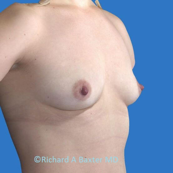 before breast augmentation angle view case 3404