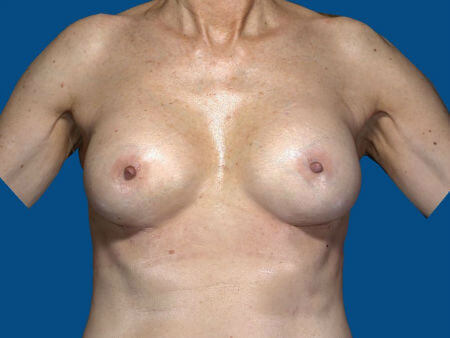 after breast augmentation front view case 3420