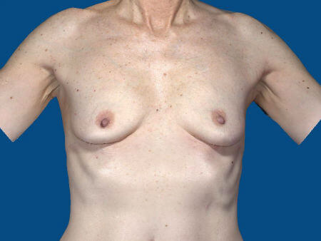 before breast augmentation front view case 3420