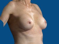 after breast augmentation angle view case 3420
