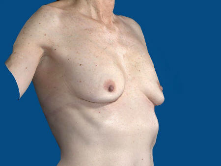 before breast augmentation angle view case 3420