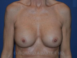after breast augmentation front view case 3430