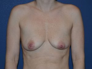 before breast augmentation front view case 3468