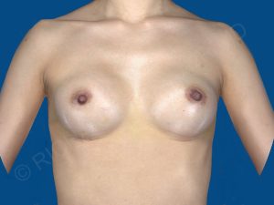 after breast augmentation front view case 3474